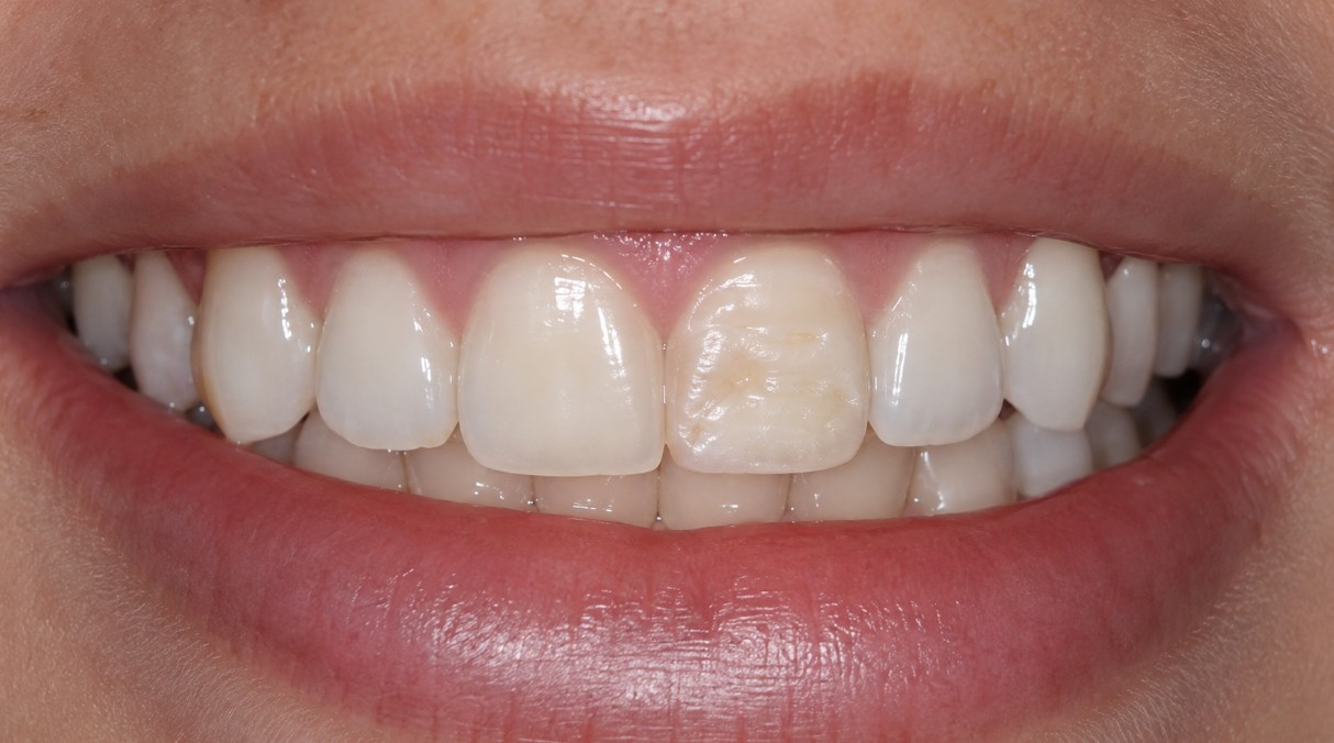 Hipoplasia dental visible en el esmalte de un incisivo
